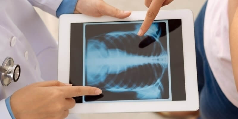  How Do You Know If Your Ribs are Broken or Cracked?