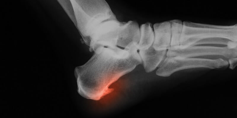  Bone Spurs