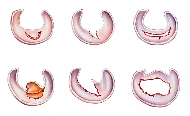 types of meniscus tears