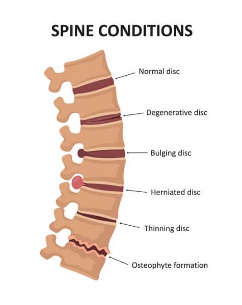 Stages of spinal osteochondrosis